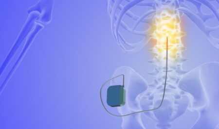 Revolutionizing Back Pain Relief with Spinal Cord Stimulation