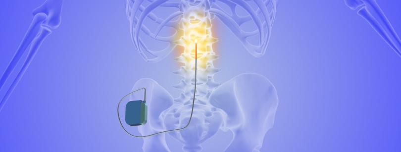 Revolutionizing Back Pain Relief with Spinal Cord Stimulation